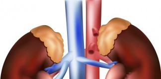 Malattia renale cronica, un’epidemia in continua crescita