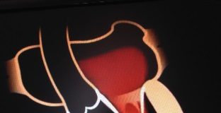 Padova, prestigioso intervento chirurgico al cuore intervento cuore