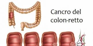 Tumore del Colon-Retto, l’importanza dello screening Tumore Colon-retto