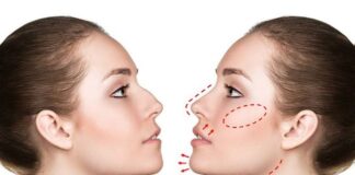 Bellezza, rimodellare il viso senza chirurgia con la Profiloplastica profiloplastica