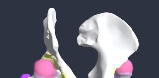 Anca dolorosa, quando ricorrere alla protesi